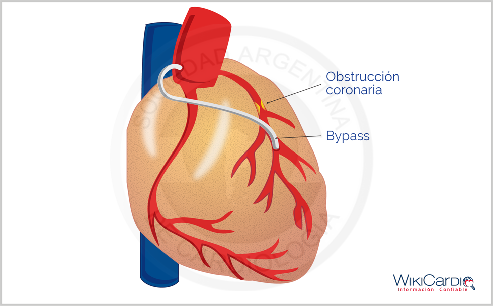 Img-bypass-de-arteria-coronaria-2.png