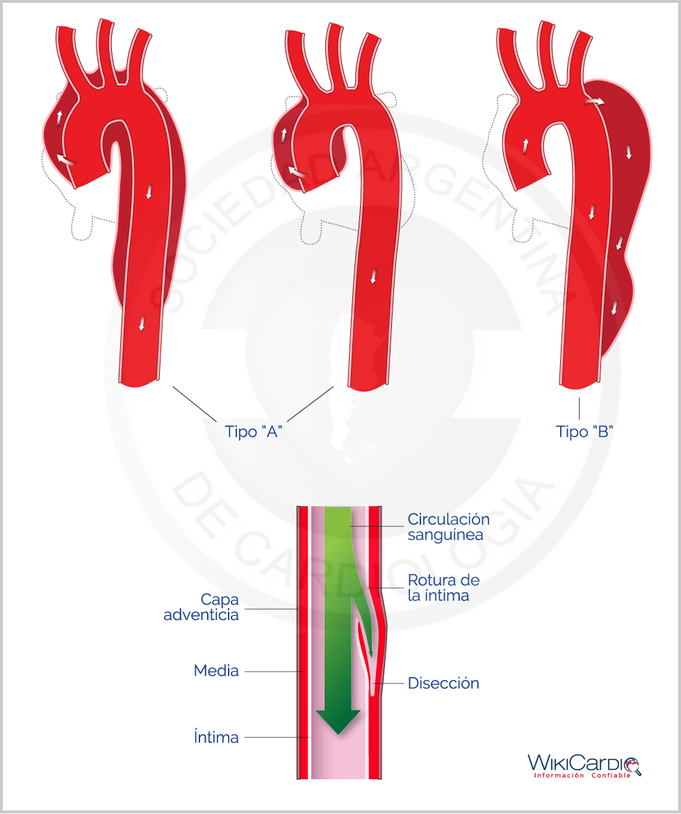 Img-diseccion-aortica-1.png