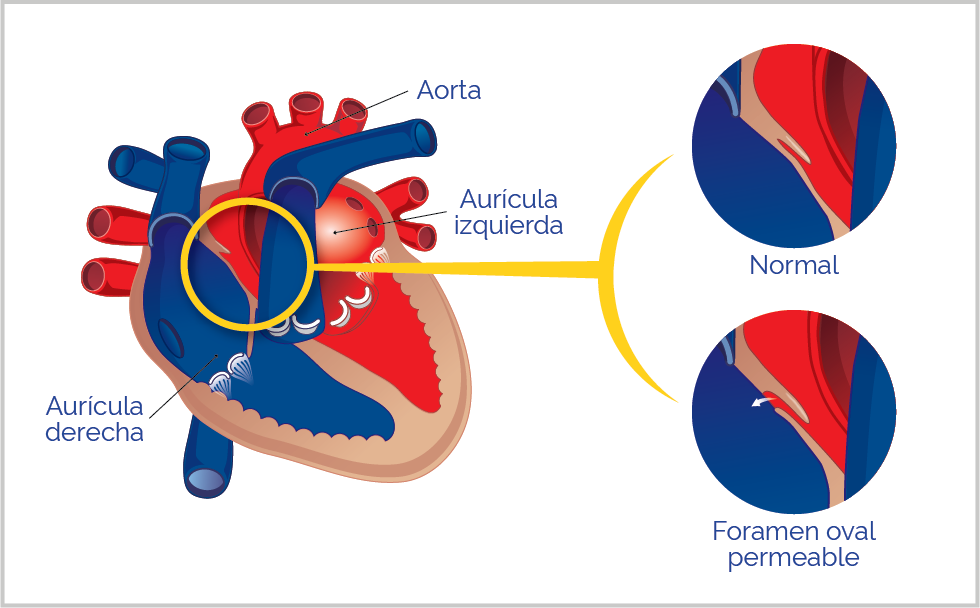 Img-foramen-oval-permeable.png