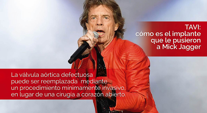 TAVI: cómo es el implante que le pusieron a Mick Jagger