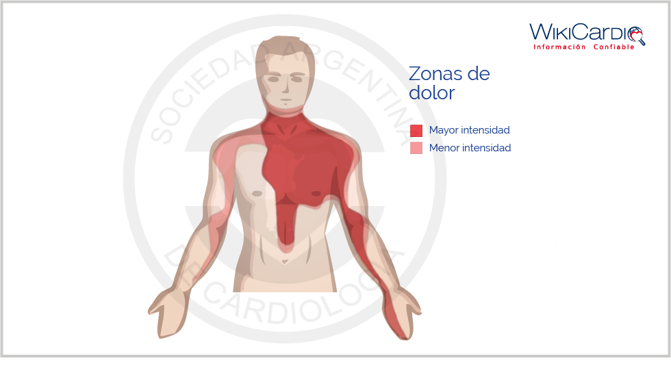 Angina de pecho - WikiCardio