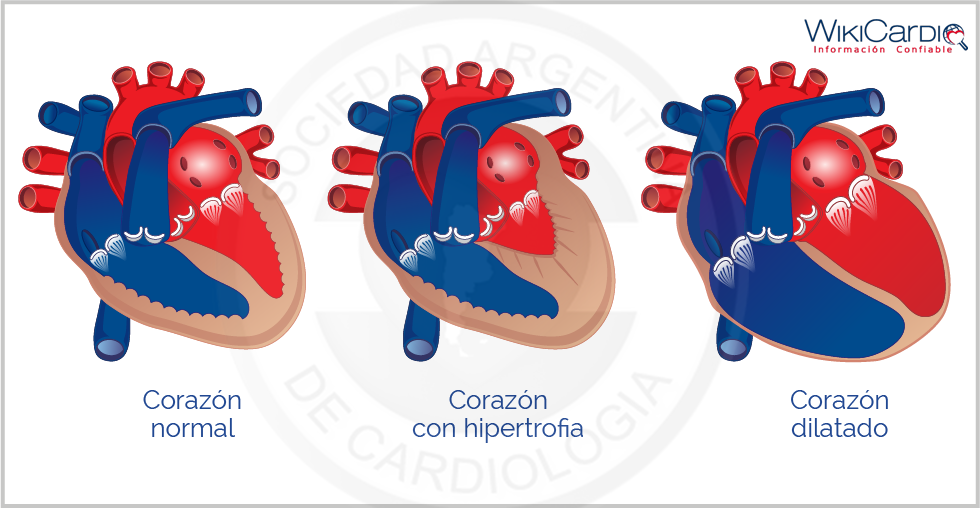 Img-hipertrofia-ventricular-izquierda-1.png