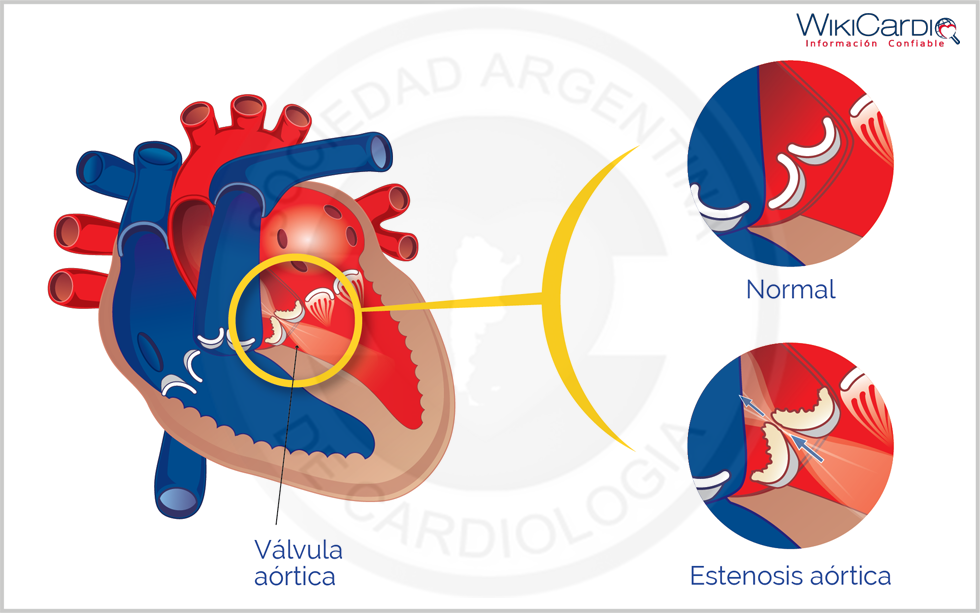 Img-estenosis-aortica-2.png