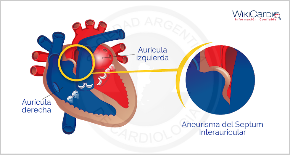 Img-aneurisma-del-septum-2.png