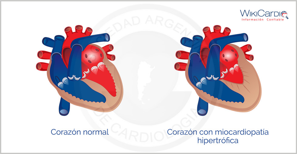 Img-miocardiopatia-herpertrofica.png