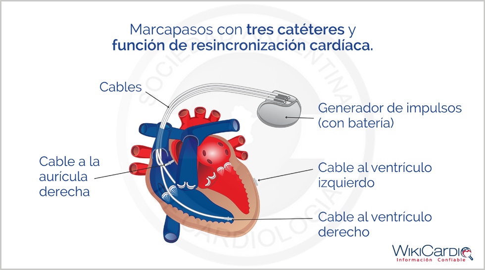 Img-resincronizacion-cardiaca.png