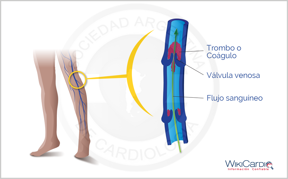 Img-trombosis-2-tromboflebitis.png