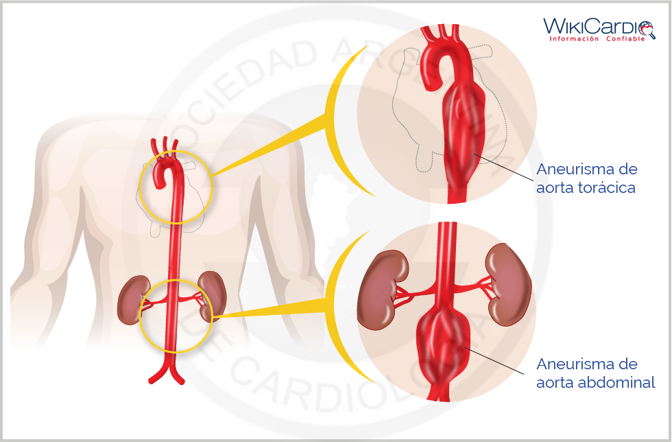 Img-aneurisma-aortico-2.png