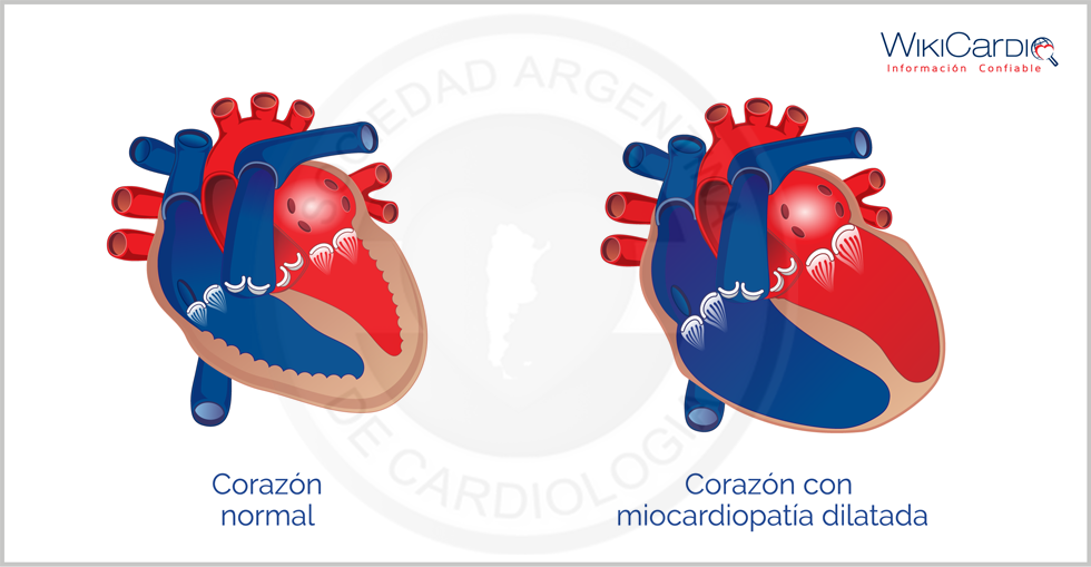 Img-miocardiopatia-dilatada.png