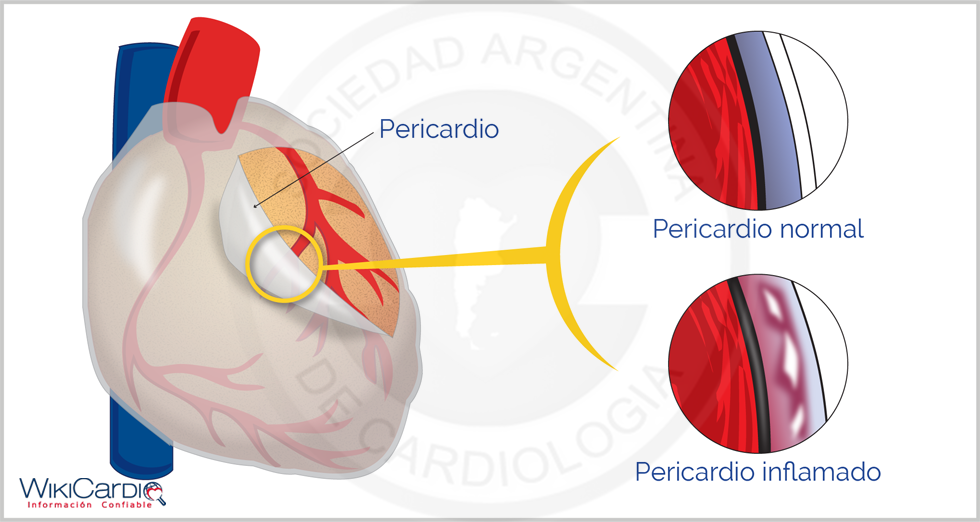 Img-pericarditis-4.png