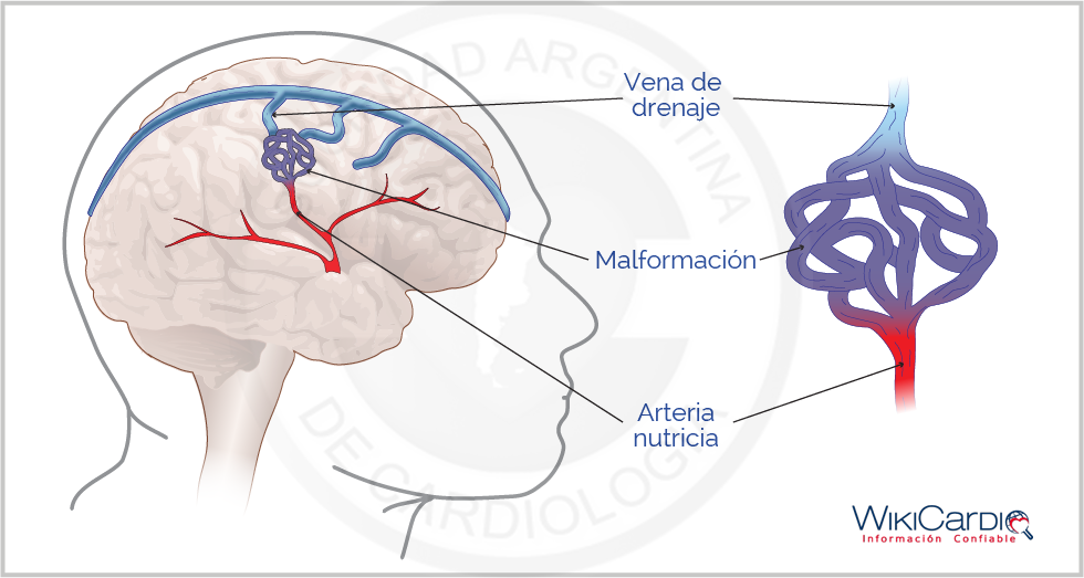 Img-malformaciones-arteriovenosas-1.png