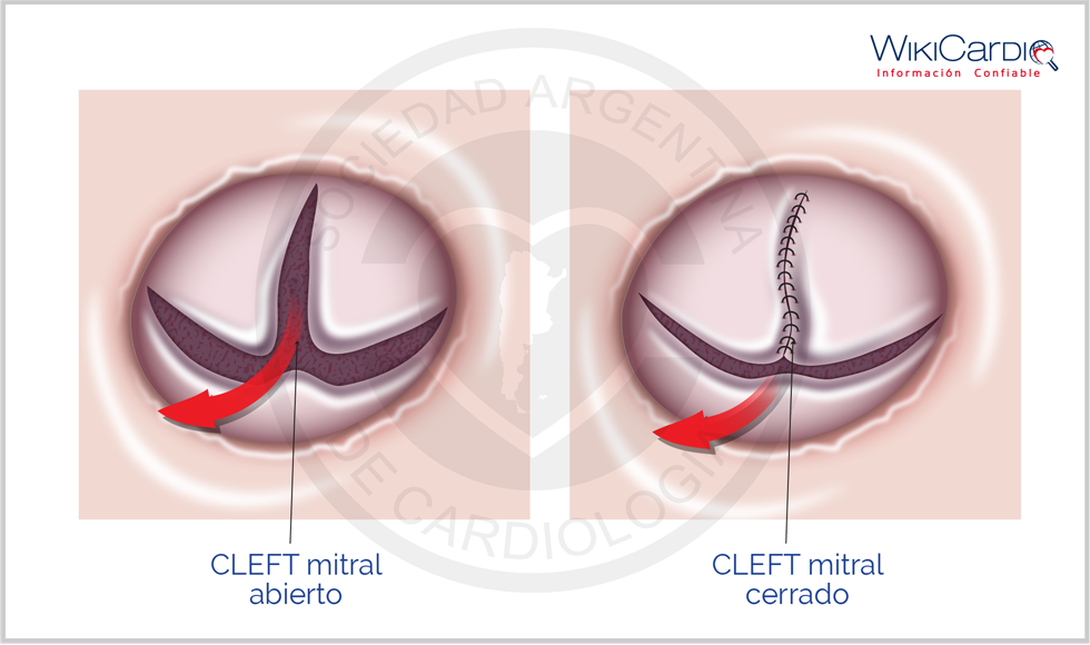 Img-cleft-mitral.png