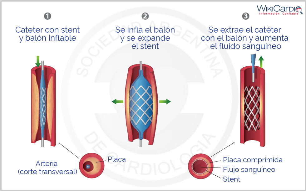 Img-angioplastia-1.png