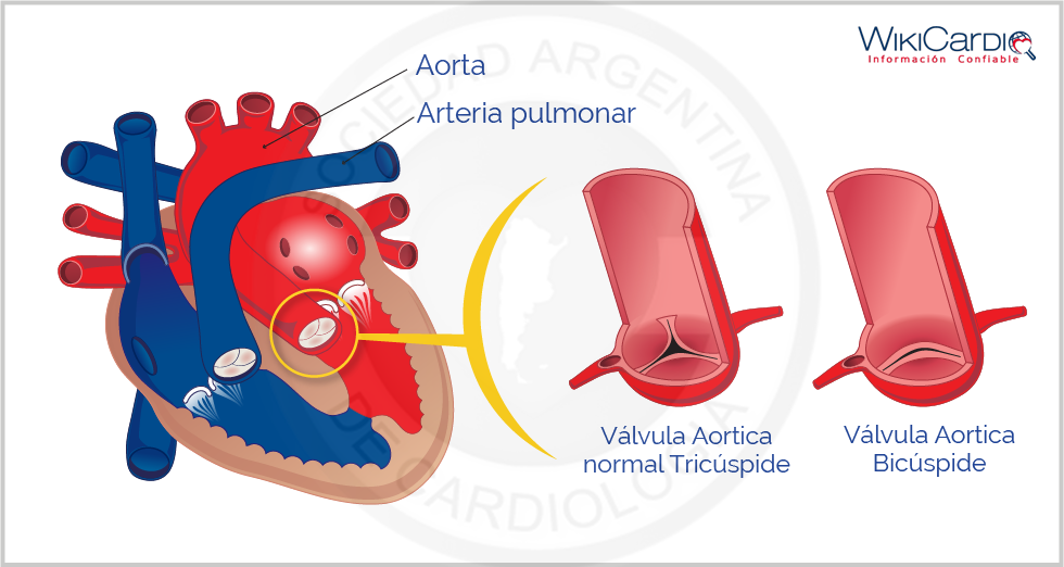 Img-valvula-aortica-bicuspide-1.png