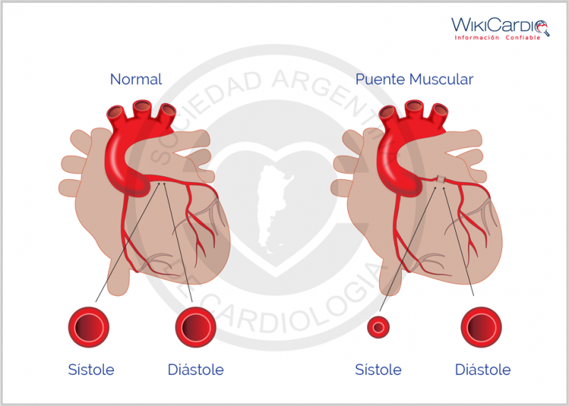 Archivo:Img-puente-muscular-coronario.png