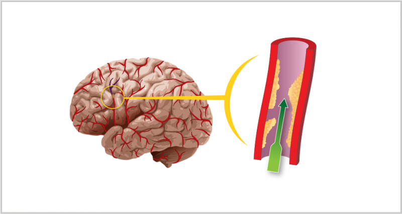Archivo:Img-enfermedad-cerebrovascular.png