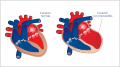 Img-miocarditis.png