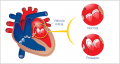 Img-prolapso-valvula-mitral.png