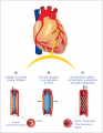 Img-stent.png