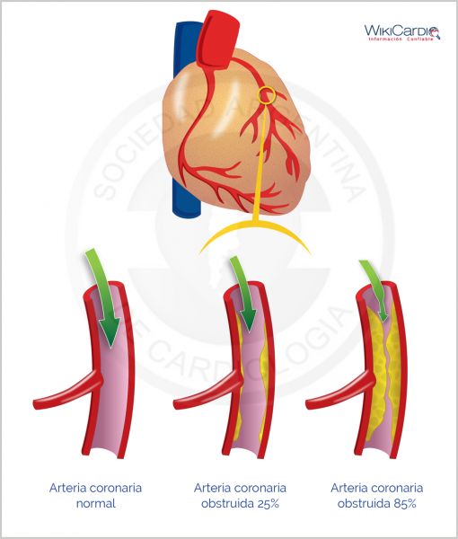 Archivo:Img-enfermedades-de-las-arterias-coronarias-aterosclerosis-1.png