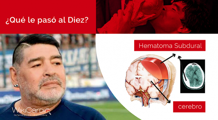 Wikinews Hematoma Maradona Wikinews Hematoma Maradona