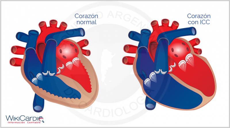Archivo:Img-insuficiencia-cardiaca-1.png