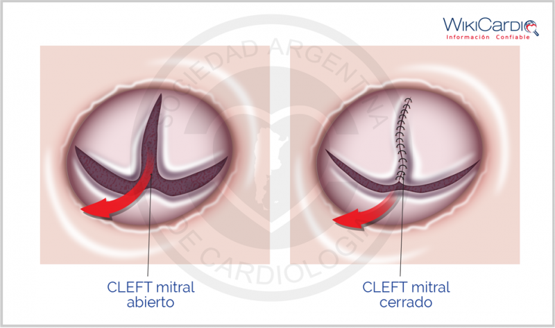 Archivo:Img-cleft-mitral.png